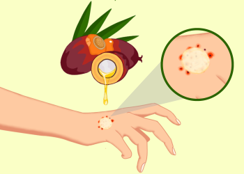 Ilustrasi Pemanfaatan Tokoferol-Tokotrienol Minyak Sawit dan Selulosa Dermatitis Atopik dalam Bentuk Dissolvable Microarray Patches. Ilustrasi: IDENTITAS/Andika Wijaya