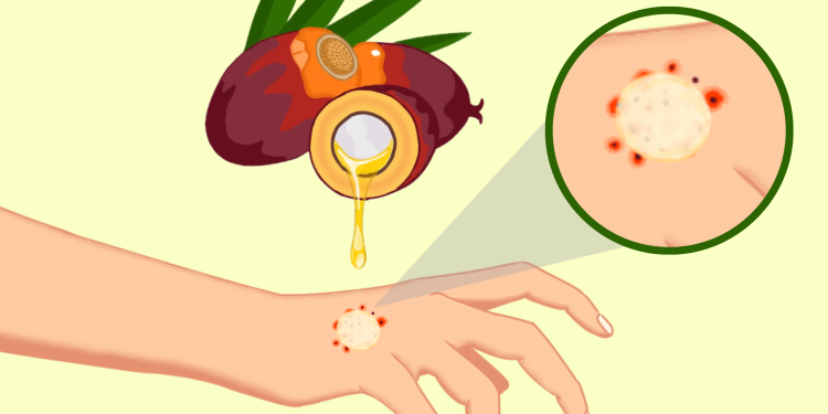 Ilustrasi Pemanfaatan Tokoferol-Tokotrienol Minyak Sawit dan Selulosa Dermatitis Atopik dalam Bentuk Dissolvable Microarray Patches. Ilustrasi: IDENTITAS/Andika Wijaya